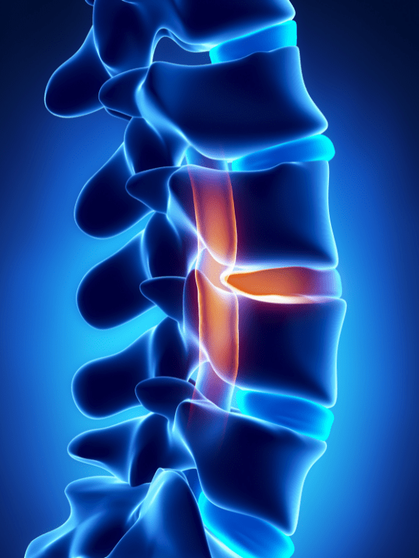 Average Herniated Disc Settlement Amount in South Carolina